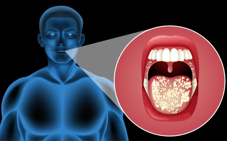 Tonsillitis (Mandelentzündung)